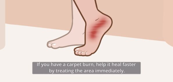 rug burn burns