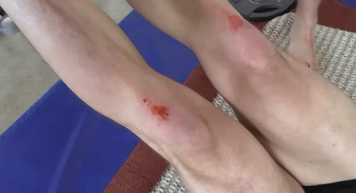 rug burn burns